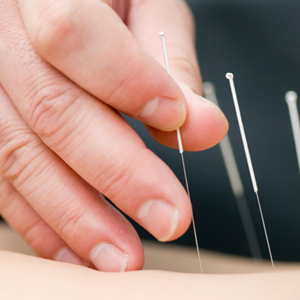 The healing treatment of acupuncture.