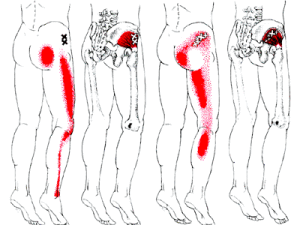 Two Kick-Butt Home Treatments for Sciatic Nerve Pain