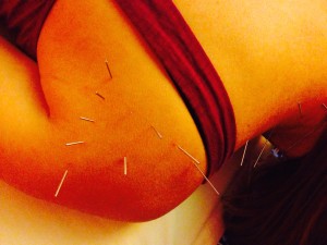 Shoulder Pain: A Visual Aid on an Acupuncture Treatment